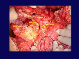 Muhtemel kanal hasarı olan proksimal yaralanmalarAmpulla sağlam ise         Eksternal drenaj          Nütrisyonal destek          İnfeksiyon kontrolü