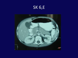 Pankreas travması: PankreatikoduodenektomiendikasyonlarıPankreas başından ve/veya yandaş damarsal yapılardan  masif, kontrol edilemeyen kanamaPankreas başında masif ve rekonstrükte edilemeyecek duktal yaralanmaRekonstrükte edilemeyecek kombine yaralanmalar:Duodenum ve pankreas başıDuodenum, pankreas başı ve koledok