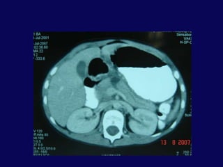 HepatoduodenalligamanPankreasDuodenum 2. kıta