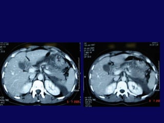  BT: pankreas orta hatta laserasyon ve peripankreatik sıvı