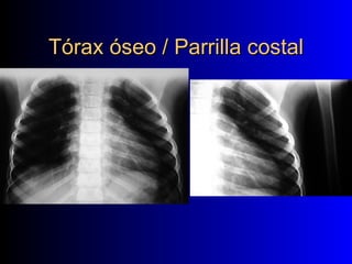 Tórax óseo / Parrilla costal
