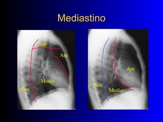 Mediastino Ant Medio Post Ant Medio Post Sup