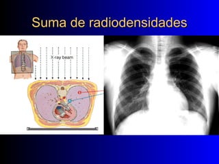Suma de radiodensidades