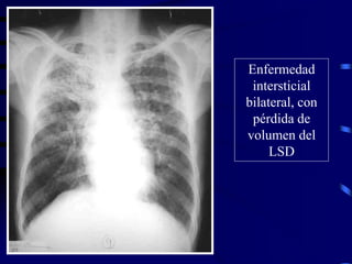 Enfermedad
intersticial
bilateral, con
pérdida de
volumen del
LSD
 