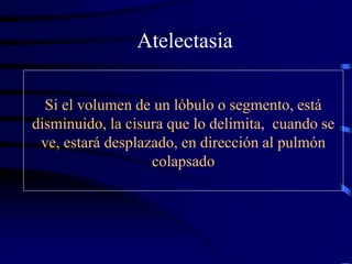 Atelectasia
Si el volumen de un lóbulo o segmento, está
disminuido, la cisura que lo delimita, cuando se
ve, estará desplazado, en dirección al pulmón
colapsado
 