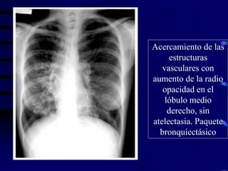 Acercamiento de las
estructuras
vasculares con
aumento de la radio
opacidad en el
lóbulo medio
derecho, sin
atelectasia. Paquete
bronquiectásico
 