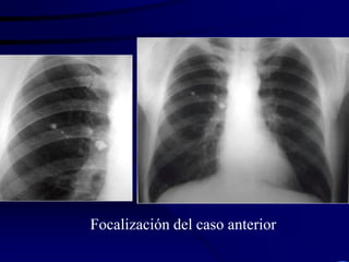 Focalización del caso anterior
 