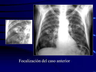 Focalización del caso anterior
 