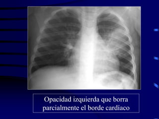Opacidad izquierda que borra
parcialmente el borde cardíaco
 