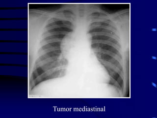 Tumor mediastinal
 