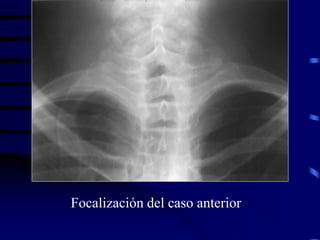 Focalización del caso anterior
 