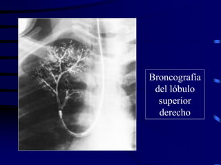 Broncografía
del lóbulo
superior
derecho
 
