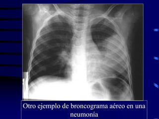 Otro ejemplo de broncograma aéreo en una
neumonía
 