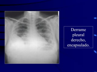 Derrame
pleural
derecho,
encapsulado.
 