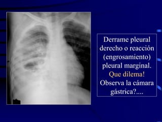 Derrame pleural
derecho o reacción
(engrosamiento)
pleural marginal.
Que dilema!
Observa la cámara
gástrica?....
 