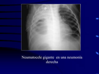 Neumatocele gigante en una neumonía
derecha
 