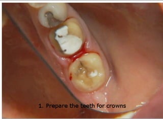 How to use Traxodent to achieve impressions with clear, defined margins