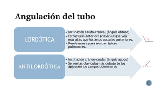• Inclinación caudo-craneal (ángulo obtuso)
• Estructuras anteriore (clavículas) se ven
más altas que los arcos costales posteriores.
• Puede usarse para evaluar ápices
pulmonares.
LORDÓTICA
• Inclinación cráneo-caudal (ángulo agudo)
• Se ven las clavículas más debajo de los
ápices en los campos pulmonaresANTILORDÓTICA
 