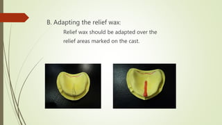 B. Adapting the relief wax:
Relief wax should be adapted over the
relief areas marked on the cast.
 