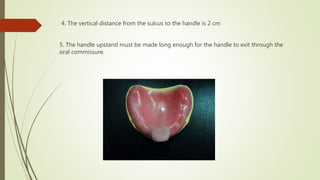 4. The vertical distance from the sulcus to the handle is 2 cm
5. The handle upstand must be made long enough for the handle to exit through the
oral commissure.
 