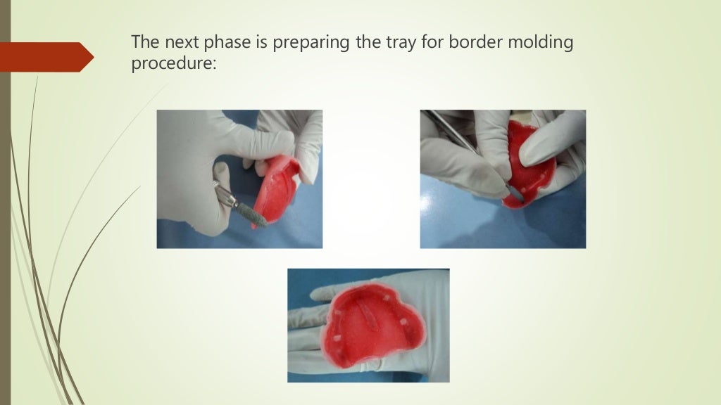 Beginner Guide to Impression Trays in Dentistry