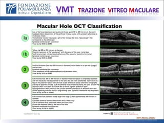 Vmt Classification Retina VITREO MACULAR Traction | PPTX