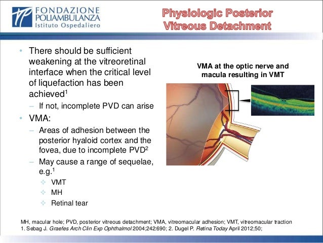 Vitreomacular Adhesion Symptoms – OCOP