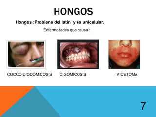 HONGOS
Hongos :Probiene del latin y es unicelular.
Enfermedades que causa :
COCCOIDIODOMICOSIS CIGOMICOSIS MICETOMA
7
 