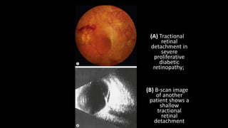Mild Tractional Rd Tractional RD | PPTX