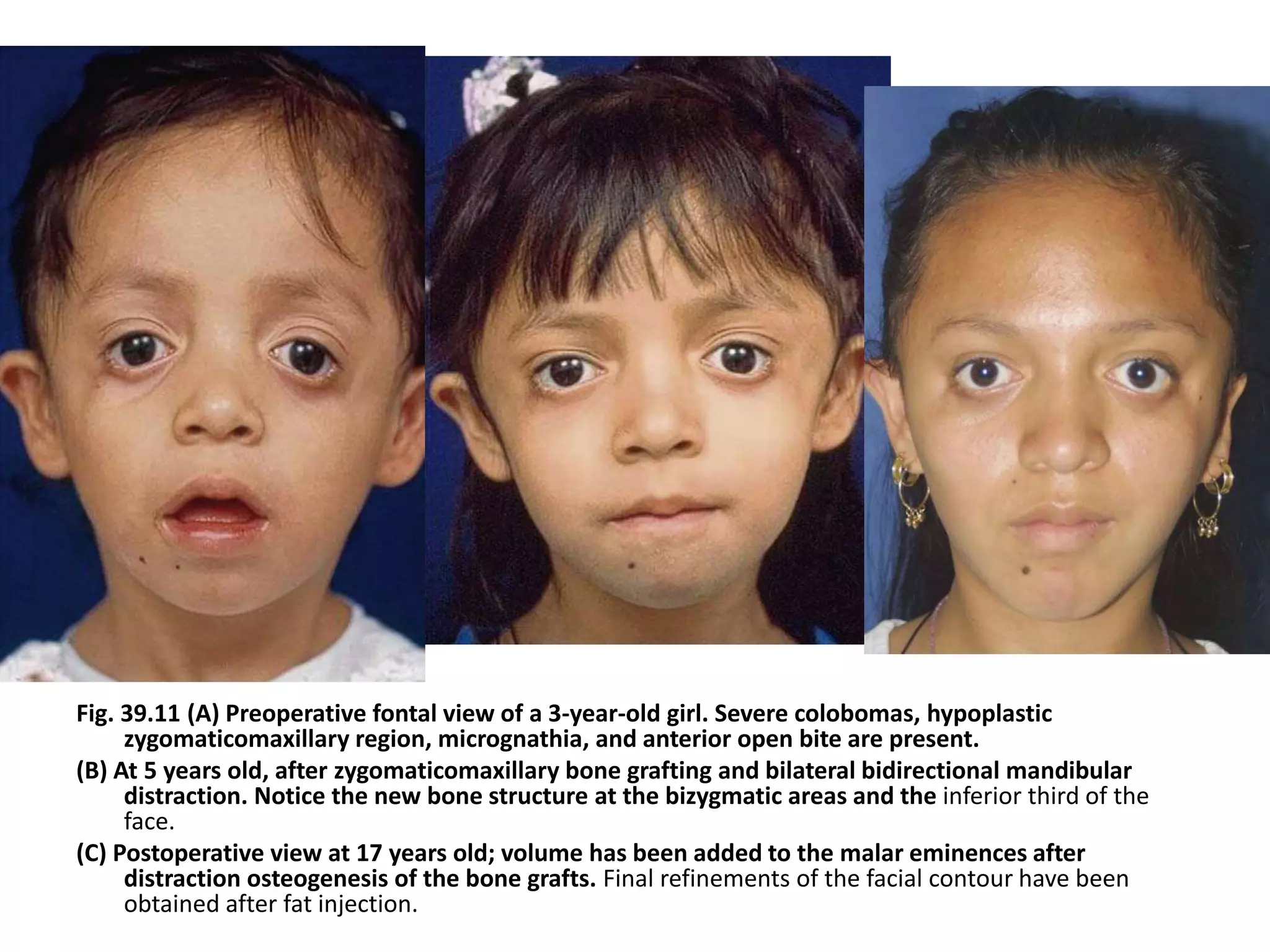 Injection Distraction Treacher colllins syndrome | PPTX