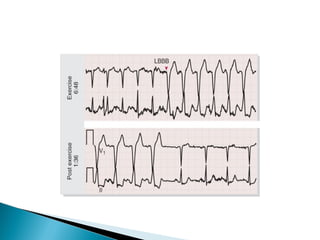 Treadmill test (TMT) | PPT