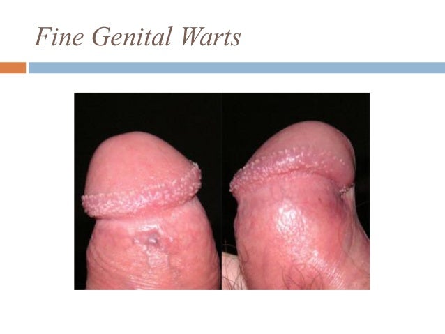 Genital herpes: MedlinePlus Medical Encyclopedia