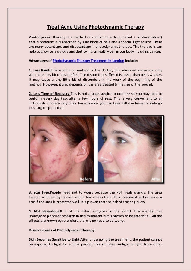 Treat Acne Using Photodynamic Therapy