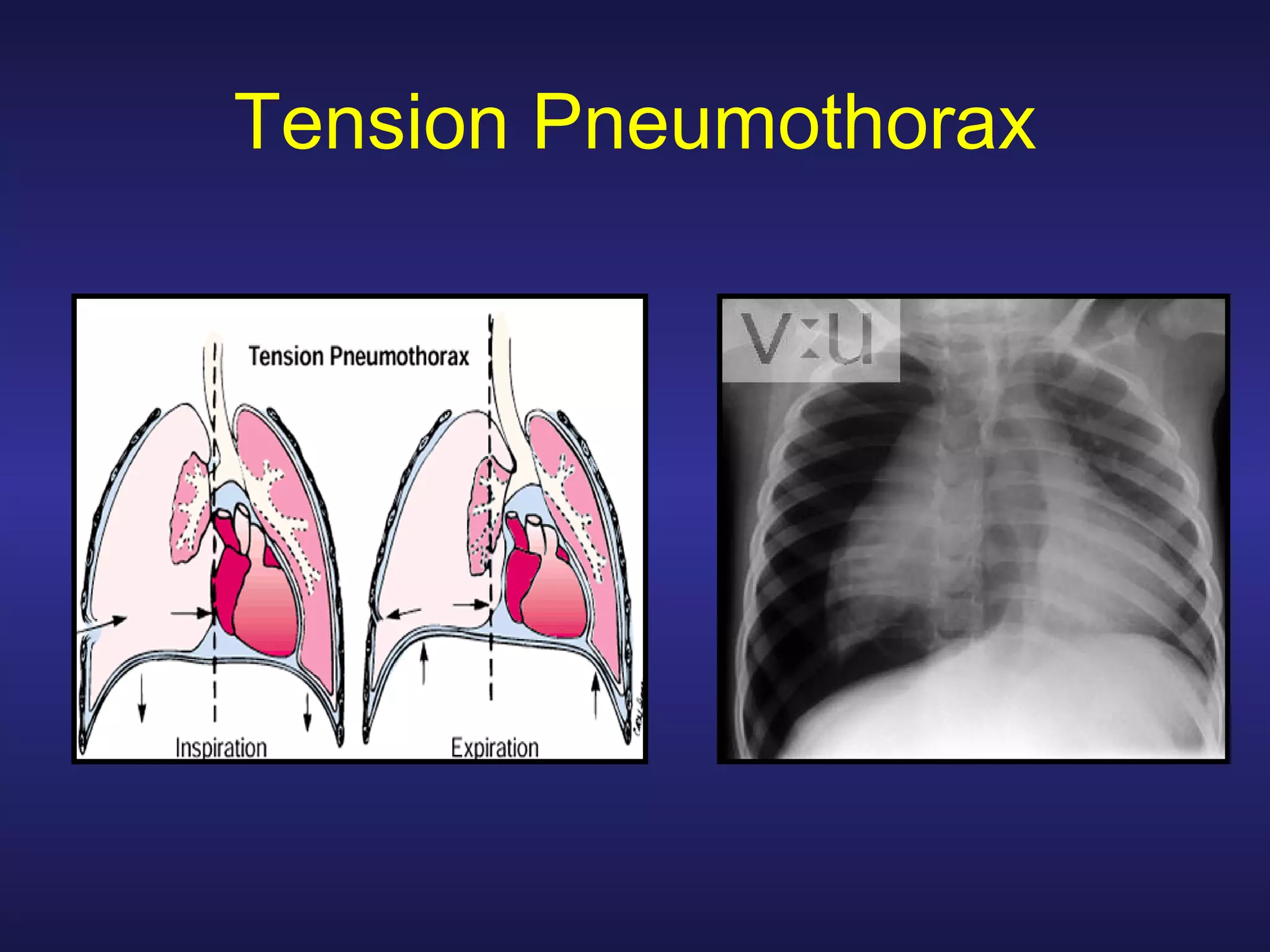 Treating Penetrating Chest Trauma | PPT