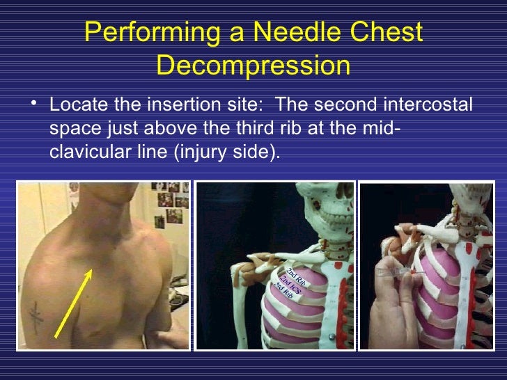Treating Chest Trauma