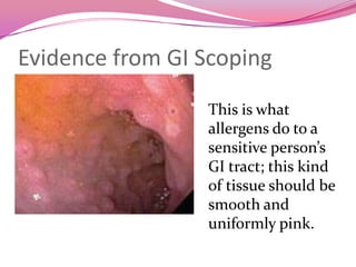 Evidence from GI ScopingThis is what allergens do to a sensitive person’s GI tract; this kind of tissue should be smooth and uniformly pink.