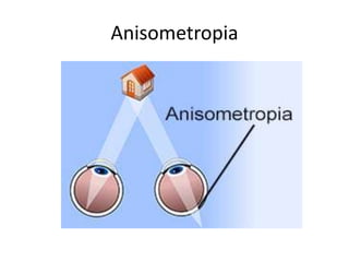 Anisometropia
 