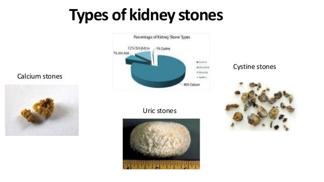 Treatment-And-Prevention-of-kidney-stone.ppt