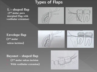 Treatment and complications of impactions | PPTX