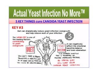5 KEY THINGS cure CANDIDA YEAST INFECTION 
KEY #3 
 