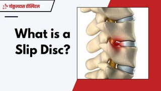 Slip Cl Disc Treatment Choices for Slip Disc at Gokuldas Hospital | PPTX