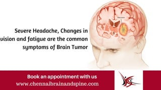 www.chennaibrainandspine.com
Book an appointment with us
Severe Headache, Changes in
vision and fatigue are the common
symptoms of Brain Tumor
 