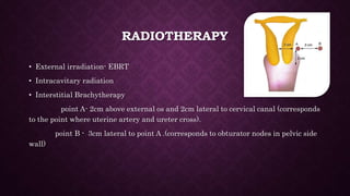 Radiation Intersititial Treatment for Carcinoma Cervix | PPTX