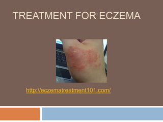 TREATMENT FOR ECZEMA




  http://eczematreatment101.com/
 