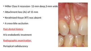 Treatment of an Advanced Gingival Recession Involving the Apex of the ...