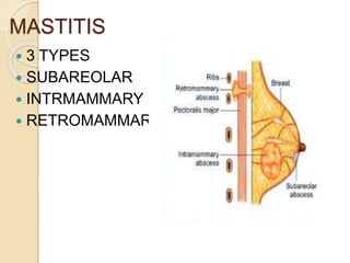 Nonpuerperal Treatment of benign breast diseases | PPTX