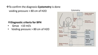 To confirm the diagnosis Cystometry is done
voiding pressure > 80 cm of H2O
Diagnostic criteria for BPH
• Qmax <10 ml/s
• Voiding pressure > 80 cm of H2O
Cytometry
 