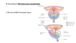 According to MC Neal zones classification
• MC site of BPH-Transition Zone
 