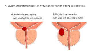  Nodule close to urethra
even small will be symptomatic
 Nodule close to urethra
even large will be asymptomatic.
• Severity of symptoms depends on Nodules and its relation of being close to urethra
 