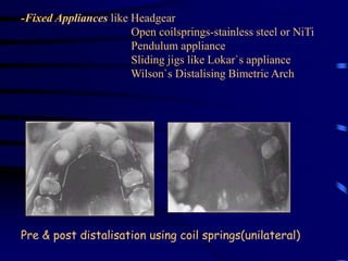 Treatment of class II | PPT